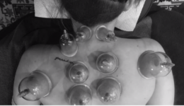 cupping