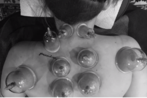 cupping