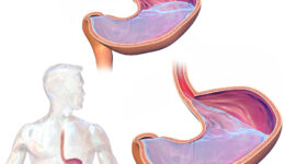 GastroEsophageal_Reflux_Disease_(GERD)